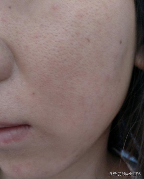 肌肤毛孔粗大出油,油性皮肤毛孔大怎么办