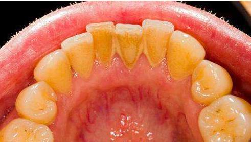 牙齿上的黄泥是什么,牙齿上的黄泥怎么去除