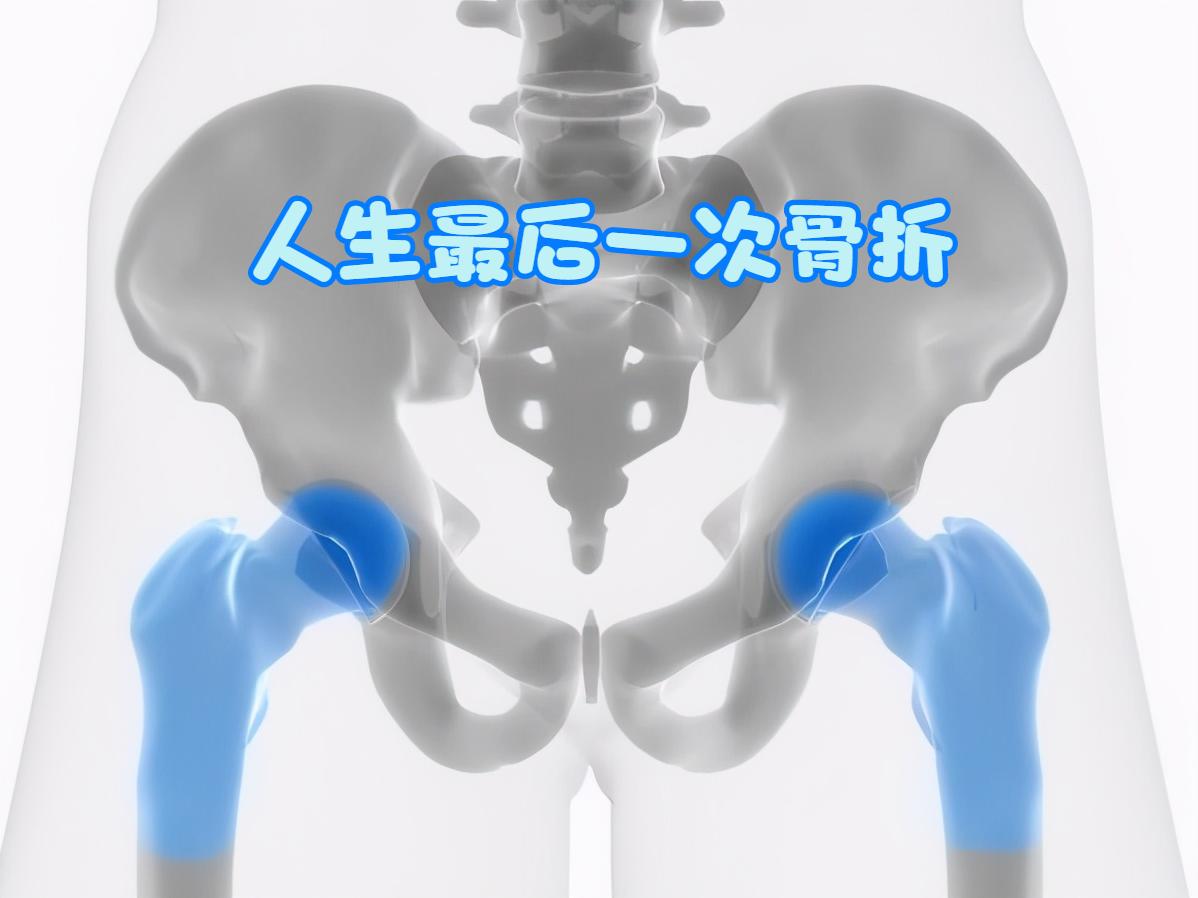 人生最后一次骨折原因,人生的最后一次骨折