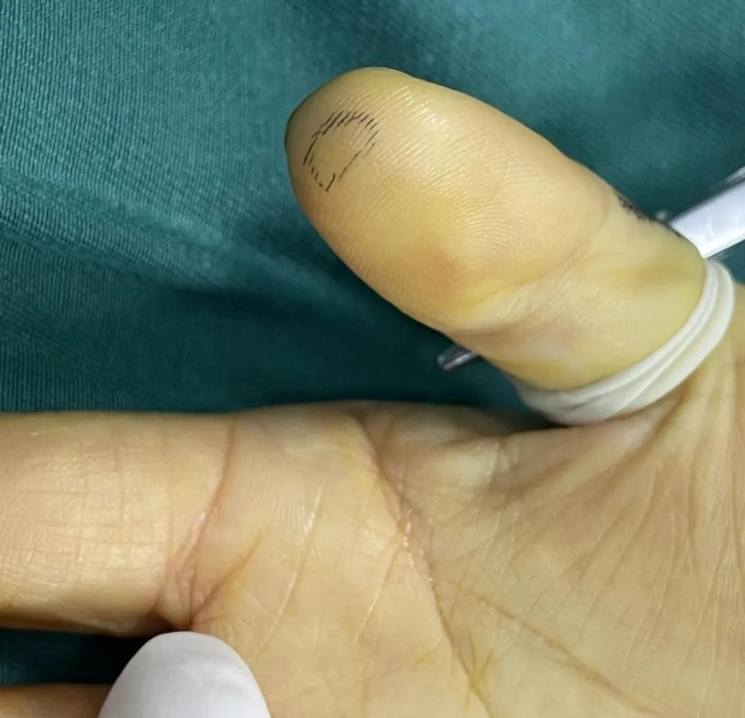 手机膜扎到肉里长好了怎么办,手机膜扎到手指里怎么办