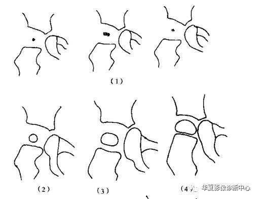 先天性髋关节脱位,先天性髋关节脱位属不属于残疾人