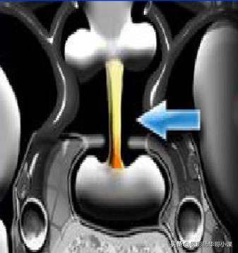 12岁垂体偏小是生长激素缺乏吗,儿童脑垂体偏小与生长激素的关系