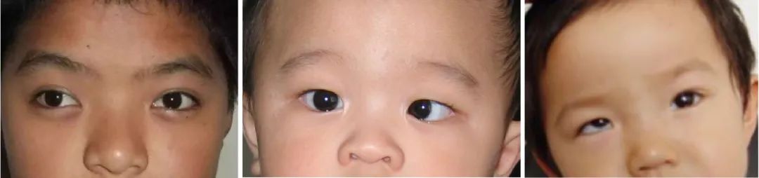 孩子总是侧头看东西?斜视治疗不及时可能失去视功能