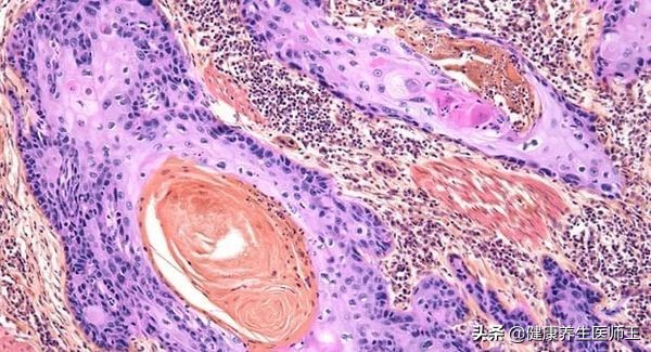 肺肿瘤标志物怎么检查,常用肿瘤标志物筛查