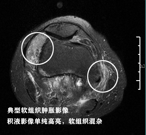 膝关节核磁共振报告单上怎么看,膝关节核磁正常报告单