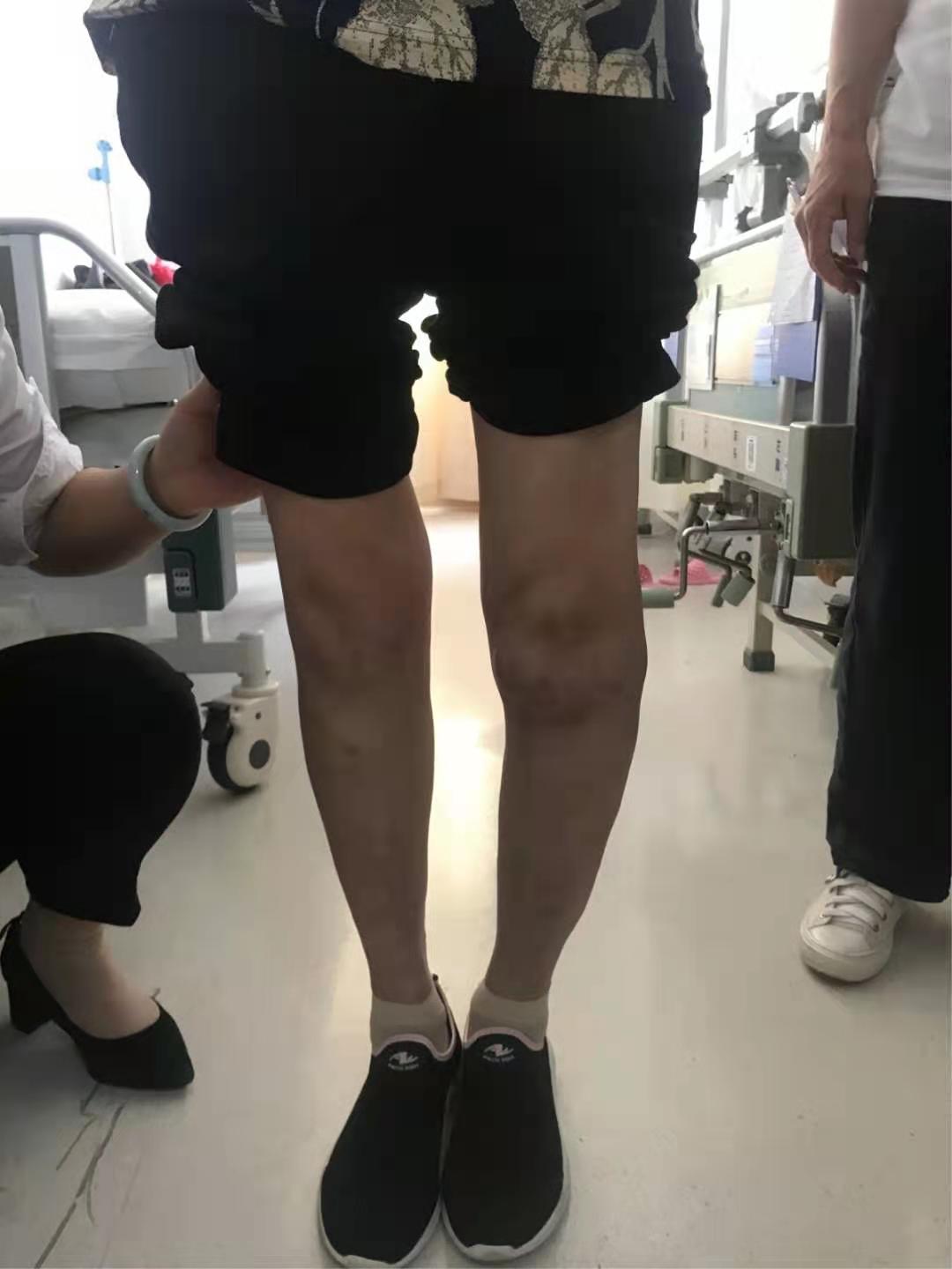 双膝功能障碍患者通过TKA手术重获行走功能