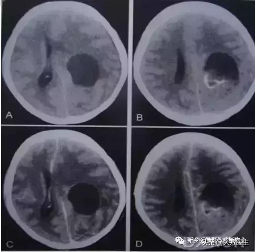 钙化灶是良性肿瘤的可能性大吗,颅内肿瘤钙化发生率最高