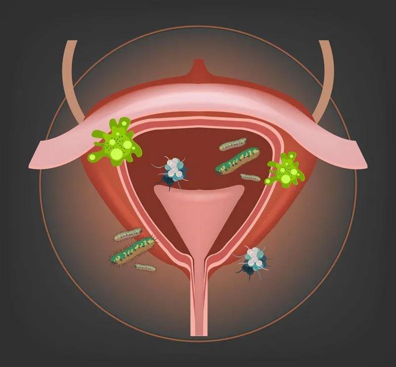 臭氧治疗妇科炎症会影响怀孕吗,有妇科炎症会怀孕吗能不能怀上