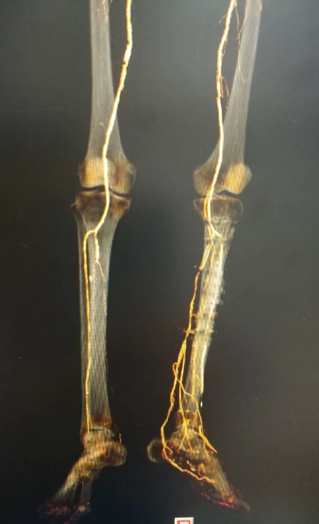 负压封闭引流治疗糖尿病足的原理,糖尿病足血管闭塞怎样治疗好