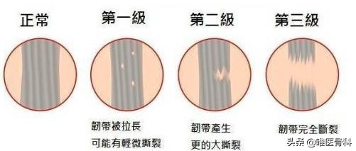 膝关节半月板损伤的相关知识,膝关节软骨损伤科普