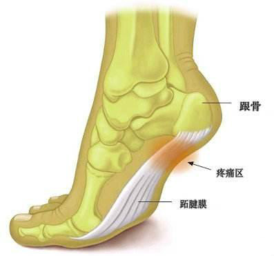 足跟跖筋膜炎是什么原因引起的,足跟跖筋膜炎刺血疗法