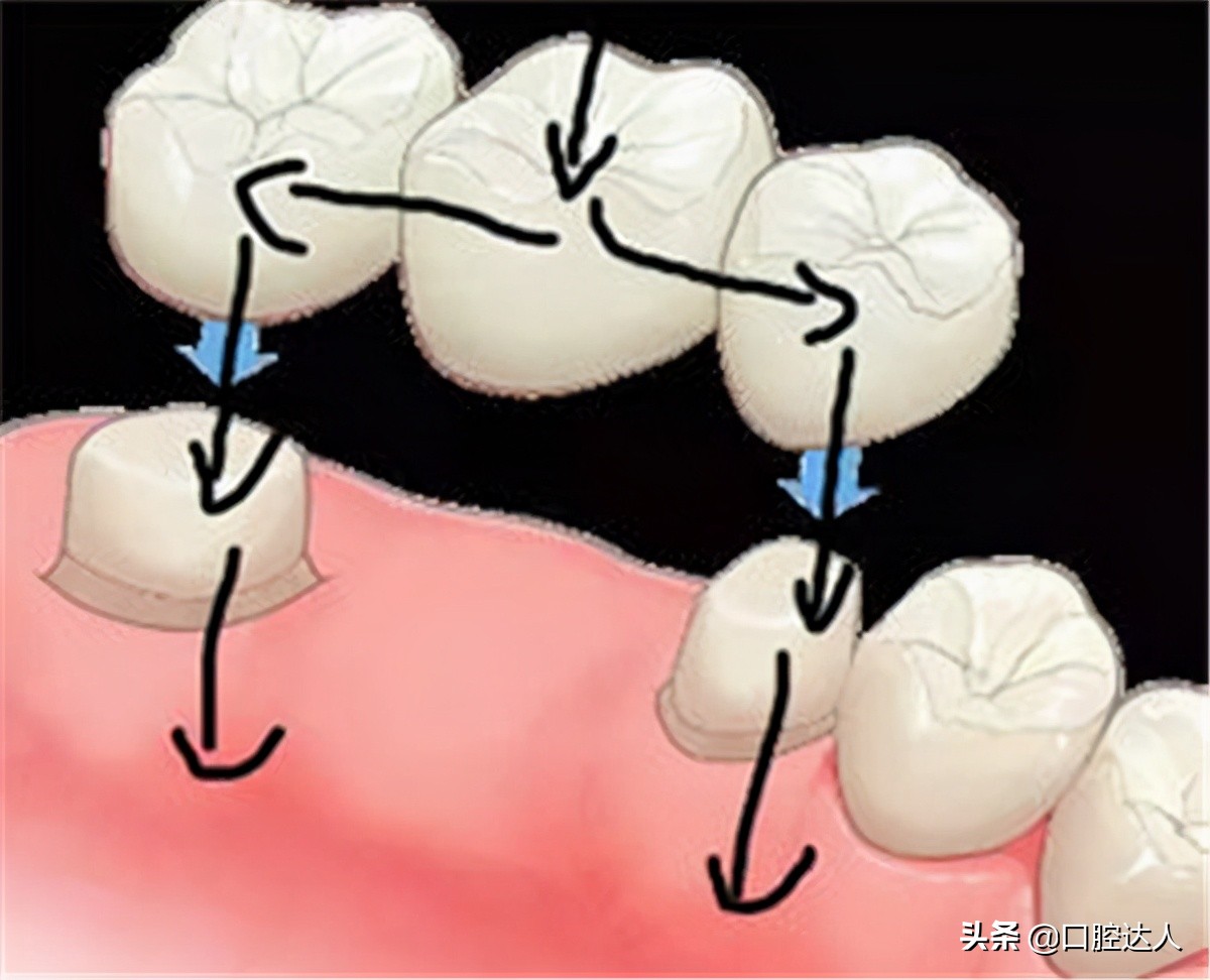 门牙掉了种植牙好还是烤瓷牙美观,门牙缺失两颗做烤瓷牙还是种植牙