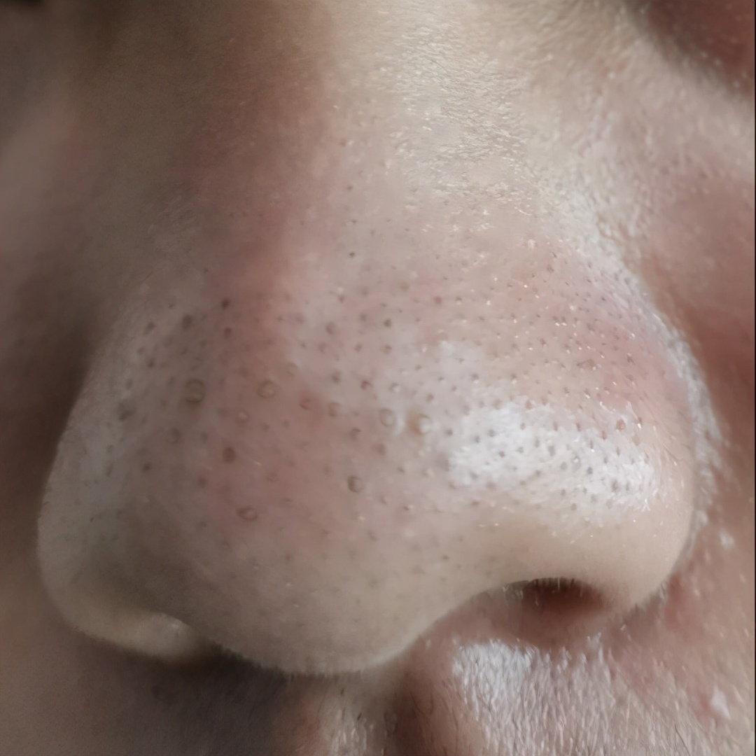 黑头如果不管它会一直在鼻子上吗,不管黑头行吗