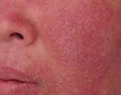 治疗激素依赖性皮炎的五大禁忌,激素依赖性皮炎治疗指南