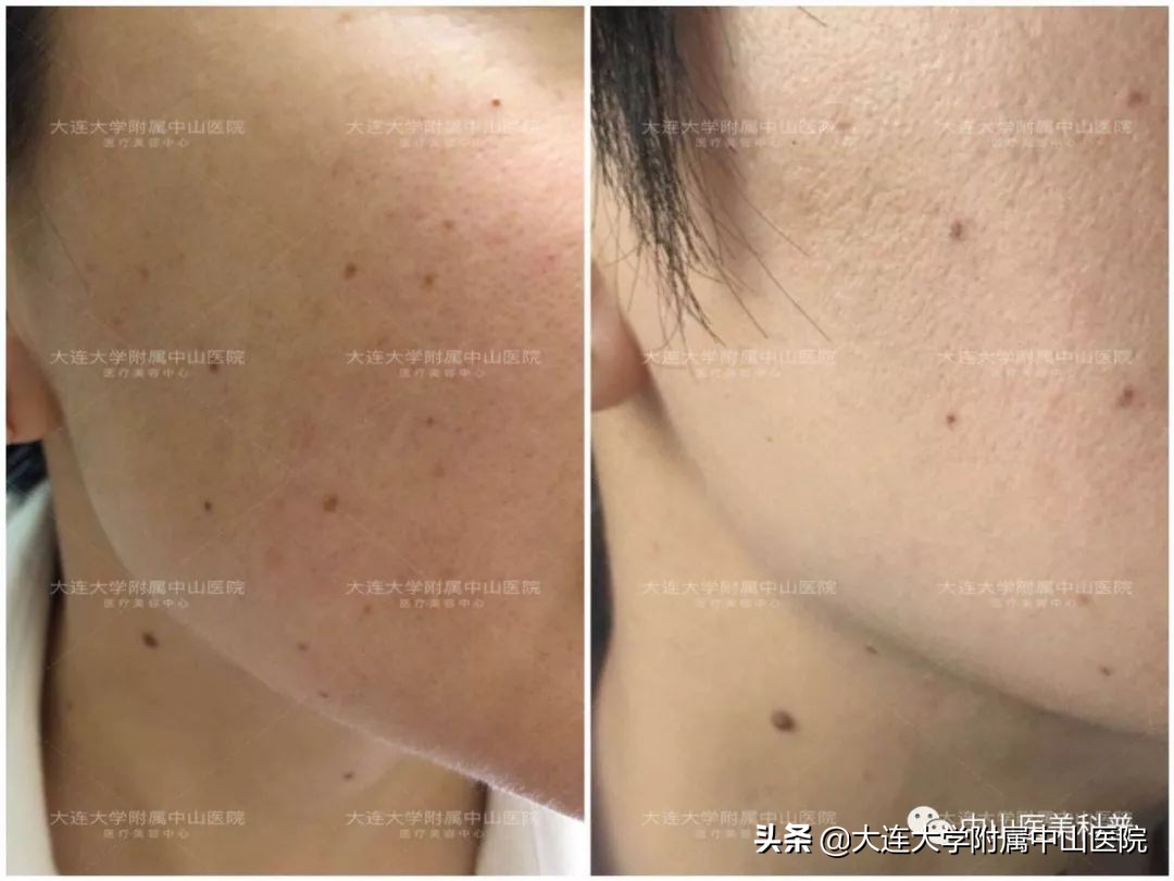 爱美人士打瘦脸针,爱美除皱针效果怎么样