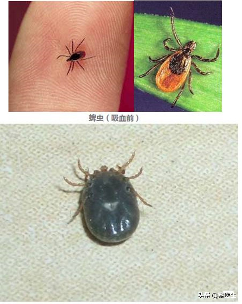 被蜱虫咬了后进icu多久可以恢复,男子被蜱虫咬后进了icu