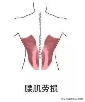 腰痛的最快的恢复办法,腰痛腰间盘突出自行康复