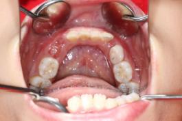 8岁的孩子能做牙齿矫正吗,7岁孩子矫正牙齿早吗