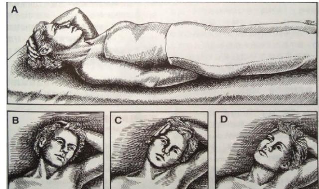 前中斜角综合症,前中斜角肌间沟有多长