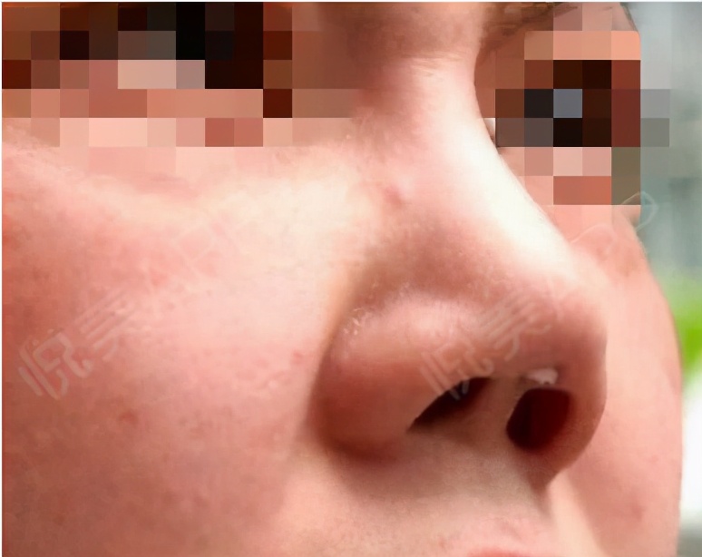 假体有保质期吗最多能用几年,水滴形假体保质期多久