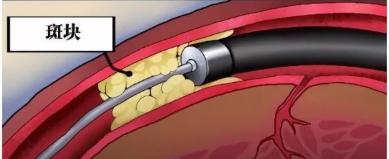 微创治疗最新技术,激光治疗新技术视频