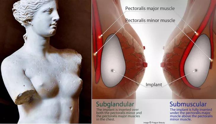 又到粉红丝带月：乳腺癌的运动防治