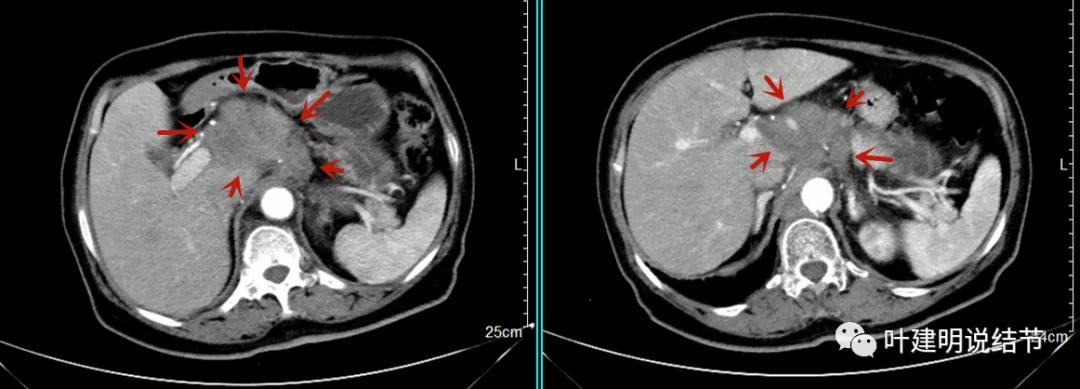 特瑞普利单抗食管癌成功案例,特瑞普利单抗治疗食管癌效果好吗
