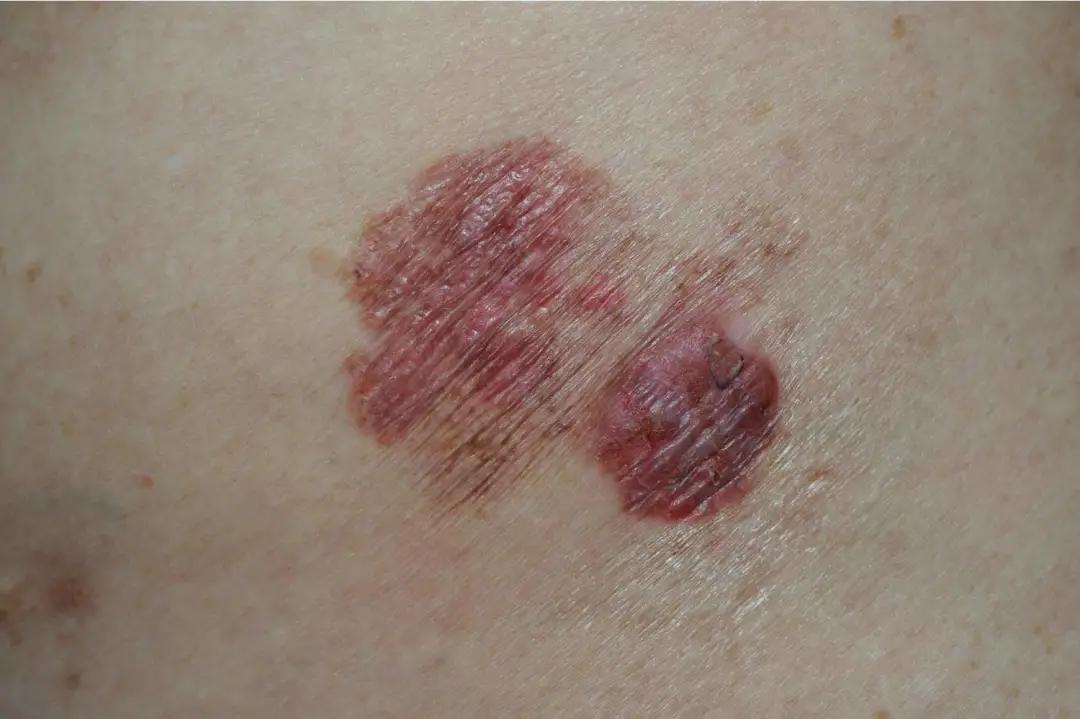 老人手长红斑,老人手上突然长了大块黑斑