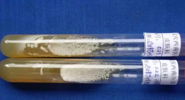 汗疱疹中医解读,专家讲汗疱疹用什么药