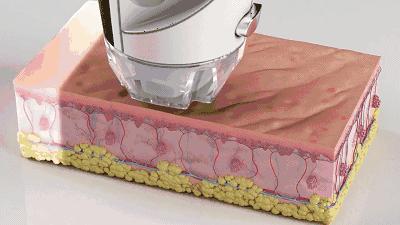 光子嫩肤能去暗沉吗,光子嫩肤反而更紧致