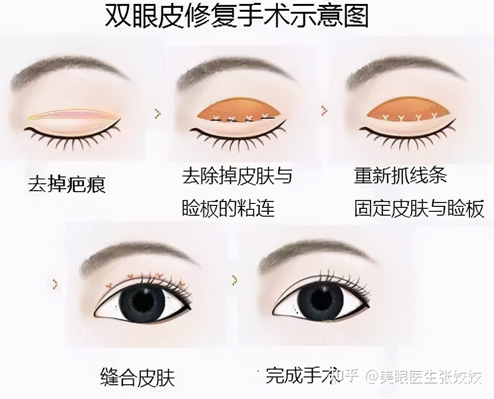 为什么割的双眼皮会显得假,为什么有的双眼皮做出来特别假