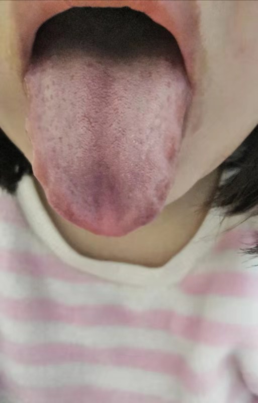 中药治疗腮腺炎、低热患者病案1例（1周）