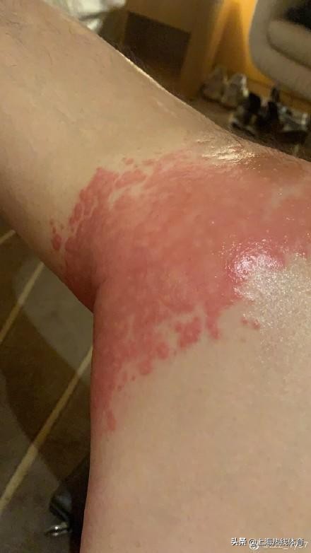 国奥队医开错药致过敏！张岩吐槽：膝盖外敷药竟是内服治疗遗精