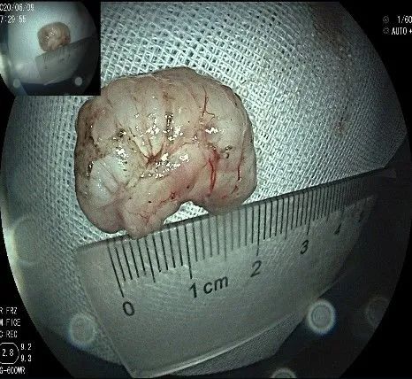 贲门隆起性病变影像,贲门溃疡隆起性病变