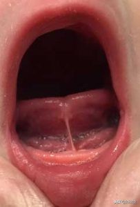 舌系带短与正常舌系带图片对比,舌系带短介绍