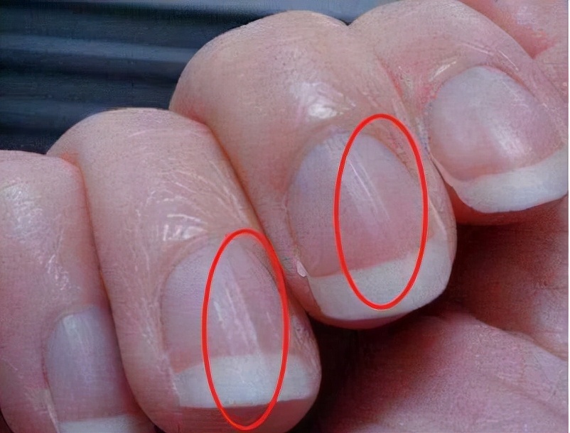 指甲上出现竖纹是身体出现了状况,如果指甲上有竖纹要注意了