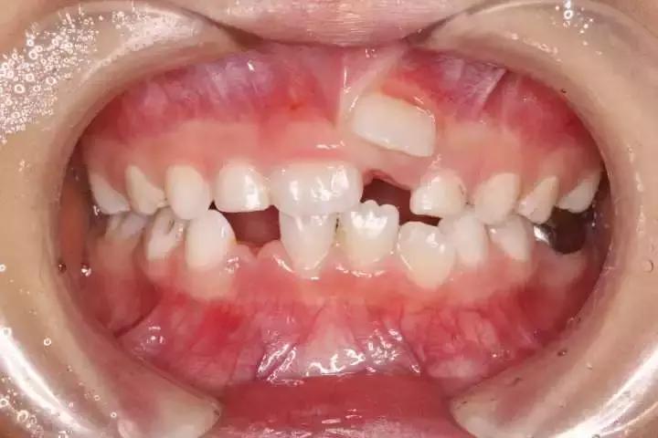 换牙期乳牙滞留恒牙歪了还能长,孩子换牙期牙齿稀疏怎么办