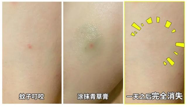 蚊子咬你都有哪些原因,蚊子咬你的真正原因是什么