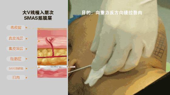 线雕和玻尿酸筋膜提升有什么区别,玻尿酸线雕是什么样子