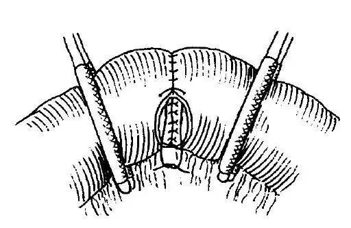 外科缝合方法笔记,兽医外科手术中最常用的缝合方法