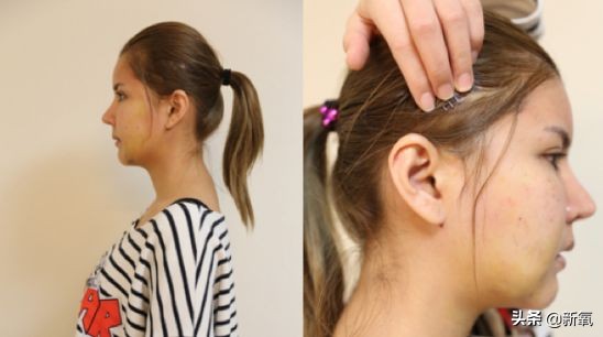 18岁土肥圆豪掷800万全身整形，鼻子6次大整假体穿出，效果却超美