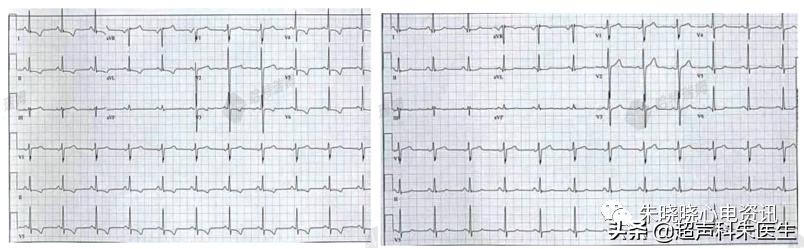 t波倒置9个真相图解,t波倒置判断口诀