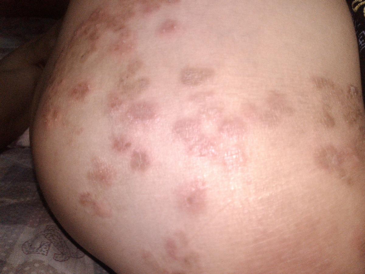 孩子出疹的最好的办法是什么,儿童常见的皮肤疹