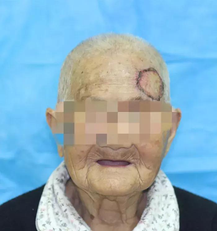 百岁老人头上长出犄角是皮肤癌吗,百岁老人头上长疙瘩