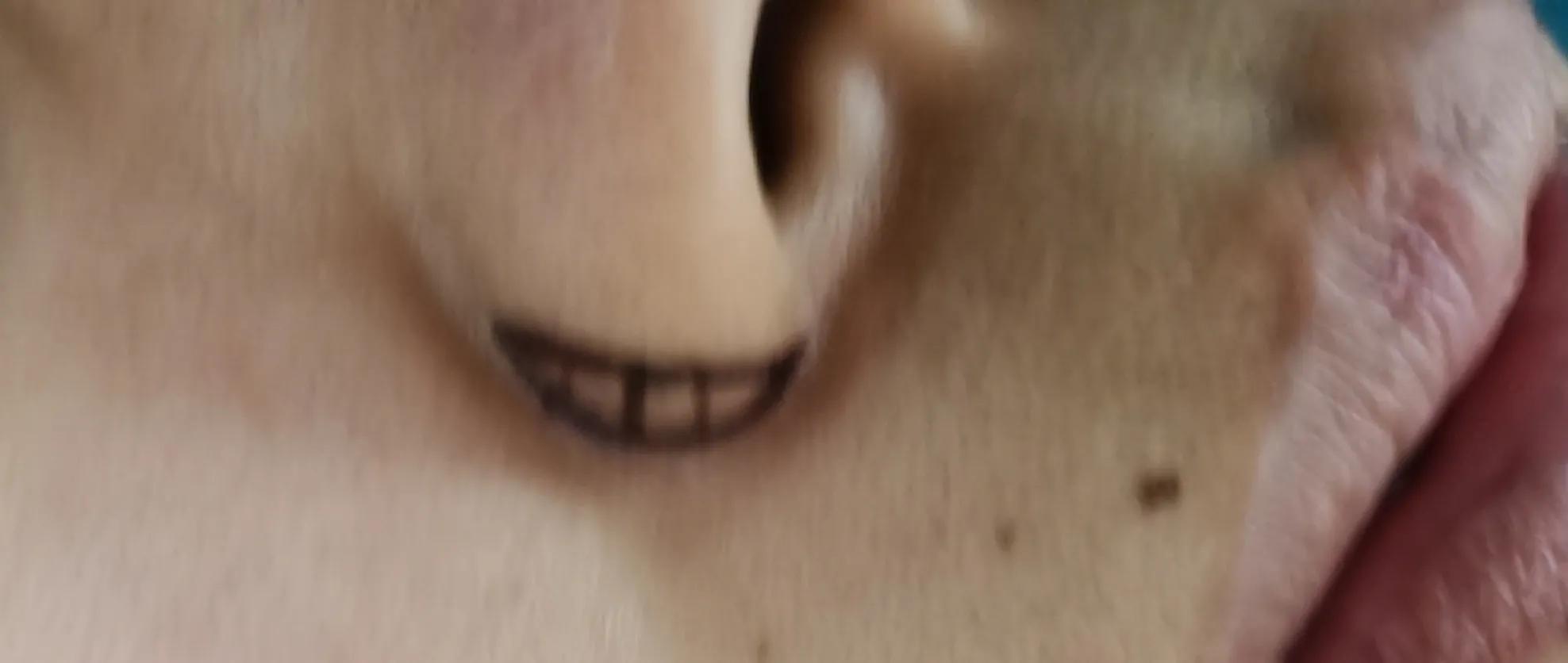 整形美容手术,鼻翼缩小术能减轻鼻基底凹陷吗