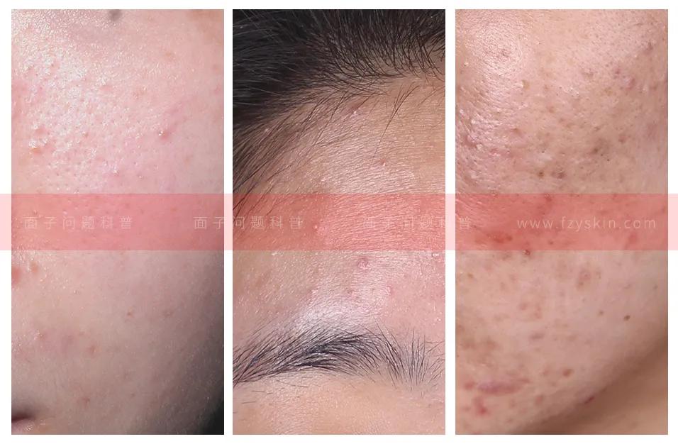 痘肌医美项目果酸焕肤,医美果酸换肤祛痘坑