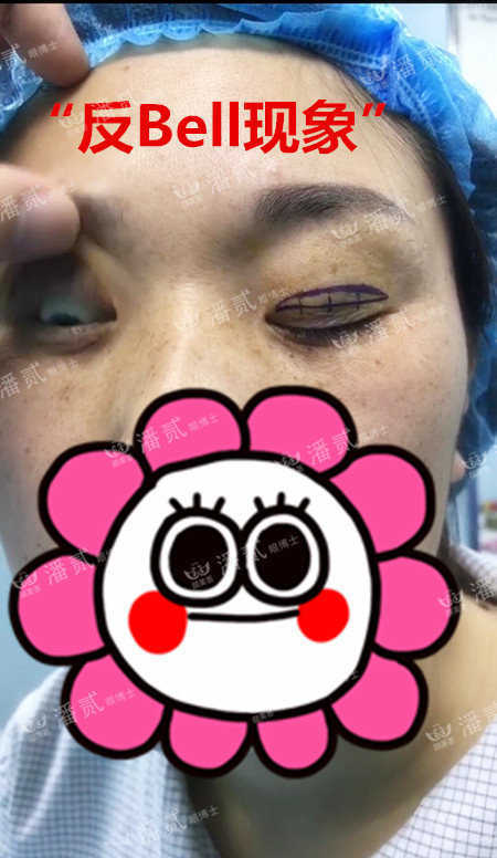 上睑下垂手术是不是永远闭不上眼,做了上睑下垂手术后怎么护理眼睛