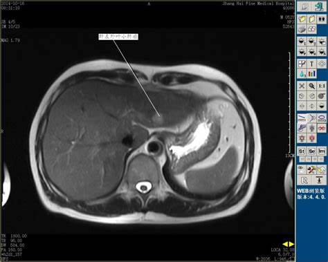慢性肝病做肝功能检查出来吗,检查肝炎抽血化验要空腹吗