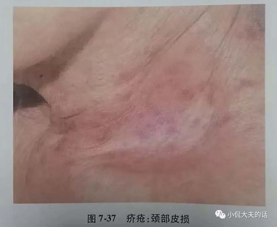 大猪猪蹄子脱落如何护理,大猪皮肤病治疗的最佳方法