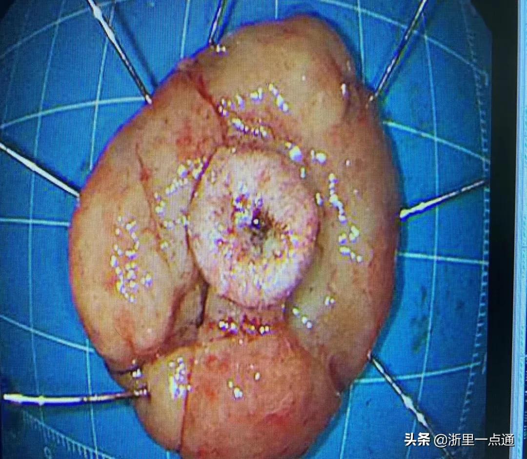 女童便血怎么回事,7岁小女孩便血怎么回事